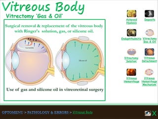Vitreous Body
Use of gas and silicone oil in vitreoretinal surgery
Vitreous
Hemorrhage
‘Mechanism’
Vitreous
Hemorrhage
Vitreous
Detachment
Vitrectomy
‘Solution’
Vitrectomy
‘Gas & Oil’
Endophthalmitis
Asteroid
Hyalosis
Deposits
Surgical removal & replacement of the vitreous body
with Ringer's solution, gas, or silicone oil.
Vitrectomy ‘Gas & Oil’
 