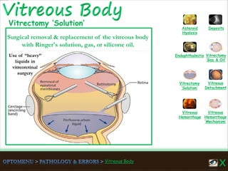 Vitreous Body
Vitreous
Hemorrhage
‘Mechanism’
Vitreous
Hemorrhage
Vitreous
Detachment
Vitrectomy
‘Solution’
Vitrectomy
‘Gas & Oil’
Endophthalmitis
Asteroid
Hyalosis
Deposits
Surgical removal & replacement of the vitreous body
with Ringer's solution, gas, or silicone oil.
Vitrectomy ‘Solution’
 