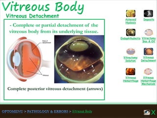 Vitreous Body
Complete posterior vitreous detachment (arrows)
Vitreous
Hemorrhage
‘Mechanism’
Vitreous
Hemorrhage
Vitreous
Detachment
Vitrectomy
‘Solution’
Vitrectomy
‘Gas & Oil’
Endophthalmitis
Asteroid
Hyalosis
Deposits
- Complete or partial detachment of the
vitreous body from its underlying tissue.
Vitreous Detachment
 