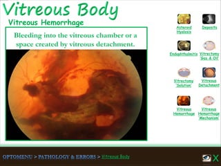 Vitreous Body
Vitreous
Hemorrhage
‘Mechanism’
Vitreous
Hemorrhage
Vitreous
Detachment
Vitrectomy
‘Solution’
Vitrectomy
‘Gas & Oil’
Endophthalmitis
Asteroid
Hyalosis
Deposits
Bleeding into the vitreous chamber or a
space created by vitreous detachment.
Vitreous Hemorrhage
 