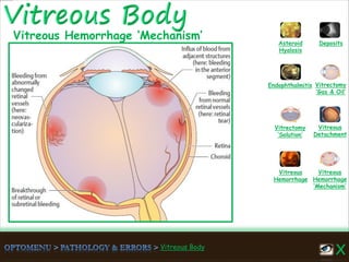 Vitreous Body
Vitreous
Hemorrhage
‘Mechanism’
Vitreous
Hemorrhage
Vitreous
Detachment
Vitrectomy
‘Solution’
Vitrectomy
‘Gas & Oil’
Endophthalmitis
Asteroid
Hyalosis
Deposits
Vitreous Hemorrhage ‘Mechanism’
 