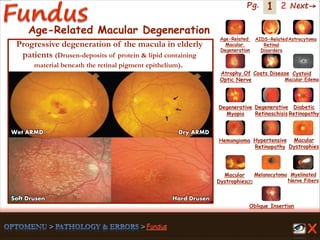 1 Next→Pg. 2
Age-Related
Macular
Degeneration
AIDS-Related
Retinal
Disorders
Astrocytoma
Atrophy Of
Optic Nerve
Coats Disease Cystoid
Macular Edema
Degenerative
Myopia
Degenerative
Retinoschisis
Diabetic
Retinopathy
Hemangioma Hypertensive
Retinopathy
Macular
Dystrophies(2)
Macular
Dystrophies
Melanocytoma Myelinated
Nerve Fibers
Oblique Insertion
Age-Related Macular Degeneration
Dry ARMDWet ARMD
Hard DrusenSoft Drusen
Progressive degeneration of the macula in elderly
patients (Drusen-deposits of protein & lipid containing
material beneath the retinal pigment epithelium).
 