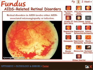 1 Next→Pg. 2
AIDS-Related Retinal Disorders
Cytomegalovirus retinitis
Retinal disorders in AIDS involve either AIDS-
associated microangiopathy or infection.
Age-Related
Macular
Degeneration
AIDS-Related
Retinal
Disorders
Astrocytoma
Atrophy Of
Optic Nerve
Coats Disease Cystoid
Macular Edema
Degenerative
Myopia
Degenerative
Retinoschisis
Diabetic
Retinopathy
Hemangioma Hypertensive
Retinopathy
Macular
Dystrophies(2)
Macular
Dystrophies
Melanocytoma Myelinated
Nerve Fibers
Oblique Insertion
 