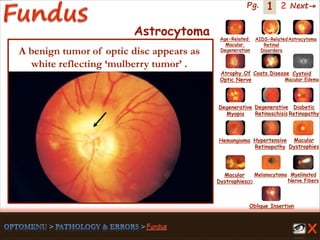 1 Next→Pg. 2
Astrocytoma
A benign tumor of optic disc appears as
white reflecting ‘mulberry tumor’ .
Age-Related
Macular
Degeneration
AIDS-Related
Retinal
Disorders
Astrocytoma
Atrophy Of
Optic Nerve
Coats Disease Cystoid
Macular Edema
Degenerative
Myopia
Degenerative
Retinoschisis
Diabetic
Retinopathy
Hemangioma Hypertensive
Retinopathy
Macular
Dystrophies(2)
Macular
Dystrophies
Melanocytoma Myelinated
Nerve Fibers
Oblique Insertion
 