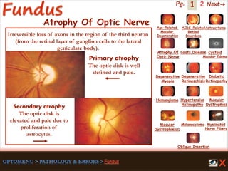 1 Next→Pg. 2
Atrophy Of Optic Nerve
Primary atrophy
The optic disk is well
defined and pale.
Secondary atrophy
The optic disk is
elevated and pale due to
proliferation of
astrocytes.
Irreversible loss of axons in the region of the third neuron
(from the retinal layer of ganglion cells to the lateral
geniculate body).
Age-Related
Macular
Degeneration
AIDS-Related
Retinal
Disorders
Astrocytoma
Atrophy Of
Optic Nerve
Coats Disease Cystoid
Macular Edema
Degenerative
Myopia
Degenerative
Retinoschisis
Diabetic
Retinopathy
Hemangioma Hypertensive
Retinopathy
Macular
Dystrophies(2)
Macular
Dystrophies
Melanocytoma Myelinated
Nerve Fibers
Oblique Insertion
 