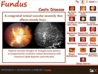 1 Next→Pg. 2
Coats Disease
Typical vascular changes of telangiectasia (arrow)
accompanied by exudative retinal detachment with
numerous lipid deposits (arrowheads).
A congenital retinal vascular anamoly that
affects mostly boys .
Age-Related
Macular
Degeneration
AIDS-Related
Retinal
Disorders
Astrocytoma
Atrophy Of
Optic Nerve
Coats Disease Cystoid
Macular Edema
Degenerative
Myopia
Degenerative
Retinoschisis
Diabetic
Retinopathy
Hemangioma Hypertensive
Retinopathy
Macular
Dystrophies(2)
Macular
Dystrophies
Melanocytoma Myelinated
Nerve Fibers
Oblique Insertion
 