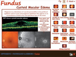 1 Next→Pg. 2
Cystoid Macular Edema
Same old Pt. with
cystoid macular
edema in the left
eye.
(a)Fundusoscopy
imaging
(b) infrared imaging
(c) Fluorescence
Angiography.
OCT shown cystoid macular edema
a b c
Originates in a disturbance of vascular permeability in the perifoveal
capillaries and/or in the retinal pigment epithelium that appears as an
accumulation of fluid in the outer plexiform layer of the retina
Age-Related
Macular
Degeneration
AIDS-Related
Retinal
Disorders
Astrocytoma
Atrophy Of
Optic Nerve
Coats Disease Cystoid
Macular Edema
Degenerative
Myopia
Degenerative
Retinoschisis
Diabetic
Retinopathy
Hemangioma Hypertensive
Retinopathy
Macular
Dystrophies(2)
Macular
Dystrophies
Melanocytoma Myelinated
Nerve Fibers
Oblique Insertion
 