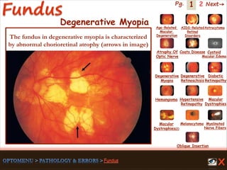 1 Next→Pg. 2
Degenerative Myopia
The fundus in degenerative myopia is characterized
by abnormal chorioretinal atrophy (arrows in image)
Age-Related
Macular
Degeneration
AIDS-Related
Retinal
Disorders
Astrocytoma
Atrophy Of
Optic Nerve
Coats Disease Cystoid
Macular Edema
Degenerative
Myopia
Degenerative
Retinoschisis
Diabetic
Retinopathy
Hemangioma Hypertensive
Retinopathy
Macular
Dystrophies(2)
Macular
Dystrophies
Melanocytoma Myelinated
Nerve Fibers
Oblique Insertion
 