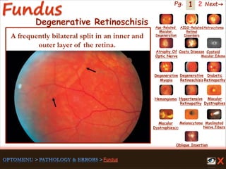 1 Next→Pg. 2
Degenerative Retinoschisis
A frequently bilateral split in an inner and
outer layer of the retina.
Age-Related
Macular
Degeneration
AIDS-Related
Retinal
Disorders
Astrocytoma
Atrophy Of
Optic Nerve
Coats Disease Cystoid
Macular Edema
Degenerative
Myopia
Degenerative
Retinoschisis
Diabetic
Retinopathy
Hemangioma Hypertensive
Retinopathy
Macular
Dystrophies(2)
Macular
Dystrophies
Melanocytoma Myelinated
Nerve Fibers
Oblique Insertion
 