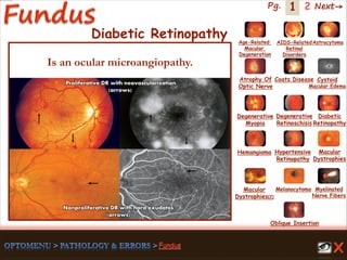 1 Next→Pg. 2
Diabetic Retinopathy
Proliferative DR with neovascularization
(arrows)
Nonproliferative DR with hard exudates
(arrows)
Is an ocular microangiopathy.
Age-Related
Macular
Degeneration
AIDS-Related
Retinal
Disorders
Astrocytoma
Atrophy Of
Optic Nerve
Coats Disease Cystoid
Macular Edema
Degenerative
Myopia
Degenerative
Retinoschisis
Diabetic
Retinopathy
Hemangioma Hypertensive
Retinopathy
Macular
Dystrophies(2)
Macular
Dystrophies
Melanocytoma Myelinated
Nerve Fibers
Oblique Insertion
 