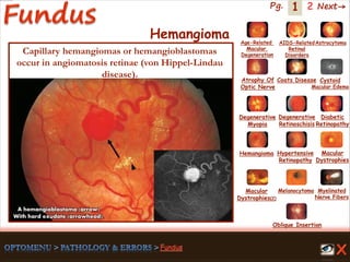 1 Next→Pg. 2
Hemangioma
A hemangioblastoma (arrow)
With hard exudate (arrowhead).
Capillary hemangiomas or hemangioblastomas
occur in angiomatosis retinae (von Hippel-Lindau
disease).
Age-Related
Macular
Degeneration
AIDS-Related
Retinal
Disorders
Astrocytoma
Atrophy Of
Optic Nerve
Coats Disease Cystoid
Macular Edema
Degenerative
Myopia
Degenerative
Retinoschisis
Diabetic
Retinopathy
Hemangioma Hypertensive
Retinopathy
Macular
Dystrophies(2)
Macular
Dystrophies
Melanocytoma Myelinated
Nerve Fibers
Oblique Insertion
 