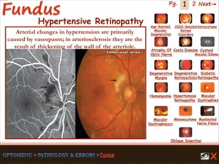 1 Next→Pg. 2
Hypertensive Retinopathy
Cotton wool (arrow)
Arterial changes in hypertension are primarily
caused by vasospasm; in arteriosclerosis they are the
result of thickening of the wall of the arteriole.
Age-Related
Macular
Degeneration
AIDS-Related
Retinal
Disorders
Astrocytoma
Atrophy Of
Optic Nerve
Coats Disease Cystoid
Macular Edema
Degenerative
Myopia
Degenerative
Retinoschisis
Diabetic
Retinopathy
Hemangioma Hypertensive
Retinopathy
Macular
Dystrophies(2)
Macular
Dystrophies
Melanocytoma Myelinated
Nerve Fibers
Oblique Insertion
 