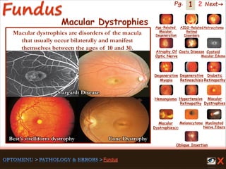 1 Next→Pg. 2
Macular Dystrophies
Stargardt Disease
Best’s vitelliform dystrophy Cone Dystrophy
Macular dystrophies are disorders of the macula
that usually occur bilaterally and manifest
themselves between the ages of 10 and 30.
Age-Related
Macular
Degeneration
AIDS-Related
Retinal
Disorders
Astrocytoma
Atrophy Of
Optic Nerve
Coats Disease Cystoid
Macular Edema
Degenerative
Myopia
Degenerative
Retinoschisis
Diabetic
Retinopathy
Hemangioma Hypertensive
Retinopathy
Macular
Dystrophies(2)
Macular
Dystrophies
Melanocytoma Myelinated
Nerve Fibers
Oblique Insertion
 