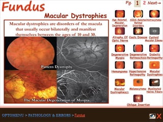 1 Next→Pg. 2
Macular Dystrophies
The Macular Degeneration of Myopia
Pattern Dystrophy
Macular dystrophies are disorders of the macula
that usually occur bilaterally and manifest
themselves between the ages of 10 and 30.
Age-Related
Macular
Degeneration
AIDS-Related
Retinal
Disorders
Astrocytoma
Atrophy Of
Optic Nerve
Coats Disease Cystoid
Macular Edema
Degenerative
Myopia
Degenerative
Retinoschisis
Diabetic
Retinopathy
Hemangioma Hypertensive
Retinopathy
Macular
Dystrophies(2)
Macular
Dystrophies
Melanocytoma Myelinated
Nerve Fibers
Oblique Insertion
 