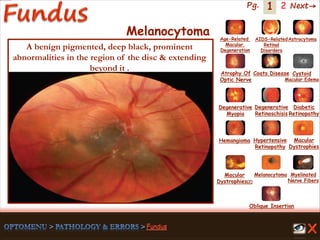 1 Next→Pg. 2
Melanocytoma
A benign pigmented, deep black, prominent
abnormalities in the region of the disc & extending
beyond it .
Age-Related
Macular
Degeneration
AIDS-Related
Retinal
Disorders
Astrocytoma
Atrophy Of
Optic Nerve
Coats Disease Cystoid
Macular Edema
Degenerative
Myopia
Degenerative
Retinoschisis
Diabetic
Retinopathy
Hemangioma Hypertensive
Retinopathy
Macular
Dystrophies(2)
Macular
Dystrophies
Melanocytoma Myelinated
Nerve Fibers
Oblique Insertion
 