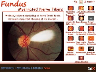 1 Next→Pg. 2
Myelinated Nerve Fibers
Whitish, striated appearing of nerve fibers & can
simulate segmental blurring of the margin .
Age-Related
Macular
Degeneration
AIDS-Related
Retinal
Disorders
Astrocytoma
Atrophy Of
Optic Nerve
Coats Disease Cystoid
Macular Edema
Degenerative
Myopia
Degenerative
Retinoschisis
Diabetic
Retinopathy
Hemangioma Hypertensive
Retinopathy
Macular
Dystrophies(2)
Macular
Dystrophies
Melanocytoma Myelinated
Nerve Fibers
Oblique Insertion
 