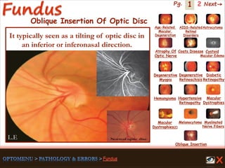 1 Next→Pg. 2
Oblique Insertion Of Optic Disc
L.E
It typically seen as a tilting of optic disc in
an inferior or inferonasal direction.
Age-Related
Macular
Degeneration
AIDS-Related
Retinal
Disorders
Astrocytoma
Atrophy Of
Optic Nerve
Coats Disease Cystoid
Macular Edema
Degenerative
Myopia
Degenerative
Retinoschisis
Diabetic
Retinopathy
Hemangioma Hypertensive
Retinopathy
Macular
Dystrophies(2)
Macular
Dystrophies
Melanocytoma Myelinated
Nerve Fibers
Oblique Insertion
 