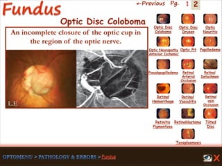 2←Previous Pg. 1
Toxoplasmosis
Retinal
Vasculitis
Tilted
Disc
Pseudopapilledema
Optic Disc
Drusen
Papilledema
Optic
Neuritis
Optic Pit
Optic Disc
Coloboma
Optic Neuropathy
‘Anterior Ischemic’
Retinal
Detachmen
Retinal
Hemorrhage
Retinal
vein
Occlusion
Retinal
Arterial
Occlusion
Retinitis
Pigmentosa
Retinoblastoma
L.E
Optic Disc Coloboma
An incomplete closure of the optic cup in
the region of the optic nerve.
 