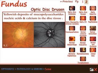 2←Previous Pg. 1
R.E
Toxoplasmosis
Retinal
Vasculitis
Tilted
Disc
Pseudopapilledema
Optic Disc
Drusen
Papilledema
Optic
Neuritis
Optic Pit
Optic Disc
Coloboma
Optic Neuropathy
‘Anterior Ischemic’
Retinal
Detachmen
Retinal
Hemorrhage
Retinal
vein
Occlusion
Retinal
Arterial
Occlusion
Retinitis
Pigmentosa
Retinoblastoma
Optic Disc Drusen
Yellowish deposits of mucopolysaccharides
nucleic acids & calcium in the disc tissue .
 