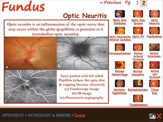 2←Previous Pg. 1
a
c
b
Same patient with left sided
Papillitis (where the optic disc
& cupping become obscured)
(a) Funduscopy image
(b) IR image
(c) Fluorescein angiography
Toxoplasmosis
Retinal
Vasculitis
Tilted
Disc
Pseudopapilledema
Optic Disc
Drusen
Papilledema
Optic
Neuritis
Optic Pit
Optic Disc
Coloboma
Optic Neuropathy
‘Anterior Ischemic’
Retinal
Detachmen
Retinal
Hemorrhage
Retinal
vein
Occlusion
Retinal
Arterial
Occlusion
Retinitis
Pigmentosa
Retinoblastoma
Optic Neuritis
Optic neuritis is an inflammation of the optic nerve that
may occur within the globe (papillitis) or posterior to it
(retrobulbar optic neuritis).
 