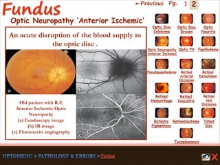 2←Previous Pg. 1
a b
c
Old patient with R.E
Anterior Ischemic Optic
Neuropathy
(a) Funduscopy image
(b) IR image
(c) Fluorescein angiography
Toxoplasmosis
Retinal
Vasculitis
Tilted
Disc
Pseudopapilledema
Optic Disc
Drusen
Papilledema
Optic
Neuritis
Optic Pit
Optic Disc
Coloboma
Optic Neuropathy
‘Anterior Ischemic’
Retinal
Detachmen
Retinal
Hemorrhage
Retinal
vein
Occlusion
Retinal
Arterial
Occlusion
Retinitis
Pigmentosa
Retinoblastoma
Optic Neuropathy ‘Anterior Ischemic’
An acute disruption of the blood supply to
the optic disc .
 