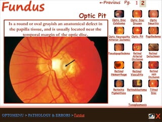 2←Previous Pg. 1
Toxoplasmosis
Retinal
Vasculitis
Tilted
Disc
Pseudopapilledema
Optic Disc
Drusen
Papilledema
Optic
Neuritis
Optic Pit
Optic Disc
Coloboma
Optic Neuropathy
‘Anterior Ischemic’
Retinal
Detachmen
Retinal
Hemorrhage
Retinal
vein
Occlusion
Retinal
Arterial
Occlusion
Retinitis
Pigmentosa
Retinoblastoma
Optic Pit
Is a round or oval grayish an anatomical defect in
the papilla tissue, and is usually located near the
temporal margin of the optic disc.
 