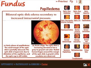 2←Previous Pg. 1
a b
(a) Early phase of papilledema:
The nasal margin of the optic
disk is partially obscured. The
optic disk is hyperemic due to
dilatation of the capillaries, and
the optic cup is still visible.
(b) Acute stage: The optic disk is
increasing elevated & has a
gray to grayish red color. Radial
hemorrhages around the margin
of the optic disk & grayish white
exudates are observed.
Toxoplasmosis
Retinal
Vasculitis
Tilted
Disc
Pseudopapilledema
Optic Disc
Drusen
Papilledema
Optic
Neuritis
Optic Pit
Optic Disc
Coloboma
Optic Neuropathy
‘Anterior Ischemic’
Retinal
Detachmen
Retinal
Hemorrhage
Retinal
vein
Occlusion
Retinal
Arterial
Occlusion
Retinitis
Pigmentosa
Retinoblastoma
Papilledema
Bilateral optic disk edema secondary to
increased intracranial pressure.
 