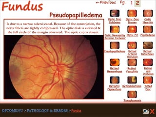 2←Previous Pg. 1
Toxoplasmosis
Retinal
Vasculitis
Tilted
Disc
Pseudopapilledema
Optic Disc
Drusen
Papilledema
Optic
Neuritis
Optic Pit
Optic Disc
Coloboma
Optic Neuropathy
‘Anterior Ischemic’
Retinal
Detachmen
Retinal
Hemorrhage
Retinal
vein
Occlusion
Retinal
Arterial
Occlusion
Retinitis
Pigmentosa
Retinoblastoma
Pseudopapilledema
Is due to a narrow scleral canal. Because of the constriction, the
nerve fibers are tightly compressed. The optic disk is elevated &
the full circle of the margin obscured. The optic cup is absent.
 