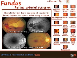 2←Previous Pg. 1
Branch Retinal Artery Occlusion (BRAO)
Toxoplasmosis
Retinal
Vasculitis
Tilted
Disc
Pseudopapilledema
Optic Disc
Drusen
Papilledema
Optic
Neuritis
Optic Pit
Optic Disc
Coloboma
Optic Neuropathy
‘Anterior Ischemic’
Retinal
Detachmen
Retinal
Hemorrhage
Retinal
vein
Occlusion
Retinal
Arterial
Occlusion
Retinitis
Pigmentosa
Retinoblastoma
Retinal arterial occlusion
Retinal infarction due to occlusion of an artery in
lamina cribrosa or a branch retinal artery occlusion.
Central Retinal Artery Occlusion (CRAO)
 