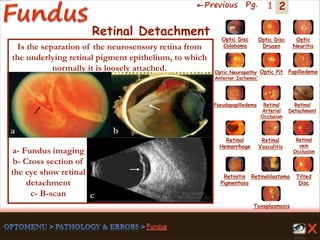 2←Previous Pg. 1
Toxoplasmosis
Retinal
Vasculitis
Tilted
Disc
Pseudopapilledema
Optic Disc
Drusen
Papilledema
Optic
Neuritis
Optic Pit
Optic Disc
Coloboma
Optic Neuropathy
‘Anterior Ischemic’
Retinal
Detachment
Retinal
Hemorrhage
Retinal
vein
Occlusion
Retinal
Arterial
Occlusion
Retinitis
Pigmentosa
Retinoblastoma
Retinal Detachment
Is the separation of the neurosensory retina from
the underlying retinal pigment epithelium, to which
normally it is loosely attached.
a- Fundus imaging
b- Cross section of
the eye show retinal
detachment
c- B-scan c
ba
 