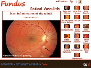 2←Previous Pg. 1
Toxoplasmosis
Retinal
Vasculitis
Tilted
Disc
Pseudopapilledema
Optic Disc
Drusen
Papilledema
Optic
Neuritis
Optic Pit
Optic Disc
Coloboma
Optic Neuropathy
‘Anterior Ischemic’
Retinal
Detachmen
Retinal
Hemorrhage
Retinal
vein
Occlusion
Retinal
Arterial
Occlusion
Retinitis
Pigmentosa
Retinoblastoma
Retinal Vasculitis
Is an inflammation of the retinal
vasculature.
vitreous infiltrates (arrow).
 