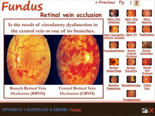 2←Previous Pg. 1
Branch Retinal Vein
Occlusion (BRVO)
Central Retinal Vein
Occlusion (CRVO)
Toxoplasmosis
Retinal
Vasculitis
Tilted
Disc
Pseudopapilledema
Optic Disc
Drusen
Papilledema
Optic
Neuritis
Optic Pit
Optic Disc
Coloboma
Optic Neuropathy
‘Anterior Ischemic’
Retinal
Detachmen
Retinal
Hemorrhage
Retinal
Vein
Occlusion
Retinal
Arterial
Occlusion
Retinitis
Pigmentosa
Retinoblastoma
Retinal vein occlusion
Is the result of circulatory dysfunction in
the central vein or one of its branches.
 