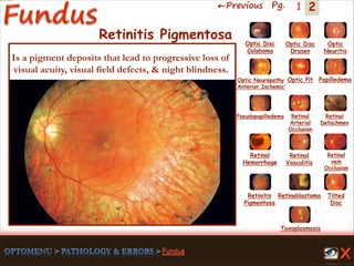 2←Previous Pg. 1
Toxoplasmosis
Retinal
Vasculitis
Tilted
Disc
Pseudopapilledema
Optic Disc
Drusen
Papilledema
Optic
Neuritis
Optic Pit
Optic Disc
Coloboma
Optic Neuropathy
‘Anterior Ischemic’
Retinal
Detachmen
Retinal
Hemorrhage
Retinal
vein
Occlusion
Retinal
Arterial
Occlusion
Retinitis
Pigmentosa
Retinoblastoma
Retinitis Pigmentosa
Is a pigment deposits that lead to progressive loss of
visual acuity, visual field defects, & night blindness.
 