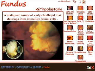 2←Previous Pg. 1
Toxoplasmosis
Retinal
Vasculitis
Tilted
Disc
Pseudopapilledema
Optic Disc
Drusen
Papilledema
Optic
Neuritis
Optic Pit
Optic Disc
Coloboma
Optic Neuropathy
‘Anterior Ischemic’
Retinal
Detachmen
Retinal
Hemorrhage
Retinal
vein
Occlusion
Retinal
Arterial
Occlusion
Retinitis
Pigmentosa
Retinoblastoma
Retinoblastoma
A malignant tumor of early childhood that
develops from immature retinal cells .
 