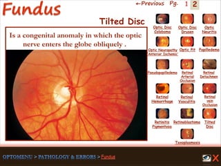 2←Previous Pg. 1
Toxoplasmosis
Retinal
Vasculitis
Tilted
Disc
Pseudopapilledema
Optic Disc
Drusen
Papilledema
Optic
Neuritis
Optic Pit
Optic Disc
Coloboma
Optic Neuropathy
‘Anterior Ischemic’
Retinal
Detachmen
Retinal
Hemorrhage
Retinal
vein
Occlusion
Retinal
Arterial
Occlusion
Retinitis
Pigmentosa
Retinoblastoma
Tilted Disc
Is a congenital anomaly in which the optic
nerve enters the globe obliquely .
 