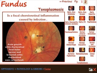 2←Previous Pg. 1
Acute grayish
white chorioretinal
focal lesion
(arrow) and
brownish white
chorioretinal
scars (arrowhead).
Toxoplasmosis
Retinal
Vasculitis
Tilted
Disc
Pseudopapilledema
Optic Disc
Drusen
Papilledema
Optic
Neuritis
Optic Pit
Optic Disc
Coloboma
Optic Neuropathy
‘Anterior Ischemic’
Retinal
Detachmen
Retinal
Hemorrhage
Retinal
vein
Occlusion
Retinal
Arterial
Occlusion
Retinitis
Pigmentosa
Retinoblastoma
Toxoplasmosis
Is a focal choroioretinal inflammation
caused by infection .
 