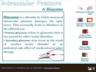 A Glaucoma A Glaucoma
Types
Congenital
Glaucoma
Glaucomatous
Optic Disc
Secondary
Glaucoma
Primary Open
Angle Glaucoma
Primary Angle
Closure Glaucoma
Glaucoma is a disorder in which increased
intraocular pressure damages the optic
nerve. This eventually leads to blindness in
the affected eye.
• Primary glaucoma: refers to glaucoma that is
not caused by other ocular disorders.
• Secondary glaucoma: may occur as the result
of another ocular disorder or an
undesired side effect of medication or other
therapy.
A Glaucoma
 