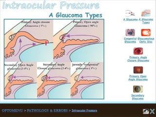 A Glaucoma Types
A Glaucoma A Glaucoma
Types
Congenital
Glaucoma
Glaucomatous
Optic Disc
Secondary
Glaucoma
Primary Open
Angle Glaucoma
Primary Angle
Closure Glaucoma
 