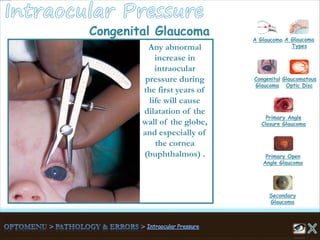 Congenital Glaucoma
A Glaucoma A Glaucoma
Types
Congenital
Glaucoma
Glaucomatous
Optic Disc
Secondary
Glaucoma
Primary Open
Angle Glaucoma
Primary Angle
Closure Glaucoma
Any abnormal
increase in
intraocular
pressure during
the first years of
life will cause
dilatation of the
wall of the globe,
and especially of
the cornea
(buphthalmos) .
 