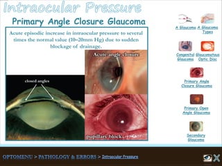closed angles
Acute angle closure
Primary Angle Closure Glaucoma
A Glaucoma A Glaucoma
Types
Congenital
Glaucoma
Glaucomatous
Optic Disc
Secondary
Glaucoma
Primary Open
Angle Glaucoma
Primary Angle
Closure Glaucoma
pupillary block
Acute episodic increase in intraocular pressure to several
times the normal value (10–20mm Hg) due to sudden
blockage of drainage.
 