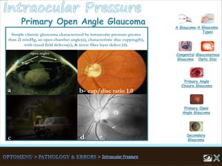 open angles
a
d
b- cup/disc ratio 1.0
Simple chronic glaucoma characterized by intraocular pressure greater
than 21 mmHg, an open chamber angle(a), characteristic disc cupping(b),
with visual field defects(c), & nerve fiber layer defect (d).
Primary Open Angle Glaucoma
A Glaucoma A Glaucoma
Types
Congenital
Glaucoma
Glaucomatous
Optic Disc
Secondary
Glaucoma
Primary Open
Angle Glaucoma
Primary Angle
Closure Glaucoma
 