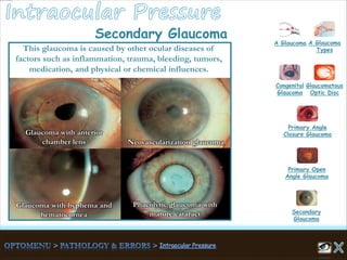 Phacolytic glaucoma with
mature cataract
Glaucoma with hyphema and
hematocornea
Glaucoma with anterior
chamber lens Neovascularization glaucoma
This glaucoma is caused by other ocular diseases of
factors such as inflammation, trauma, bleeding, tumors,
medication, and physical or chemical influences.
Secondary Glaucoma
A Glaucoma A Glaucoma
Types
Congenital
Glaucoma
Glaucomatous
Optic Disc
Secondary
Glaucoma
Primary Open
Angle Glaucoma
Primary Angle
Closure Glaucoma
 