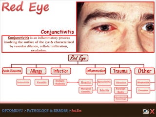 Endoph-
thalmitis
Keratitis
Scleritis
Marginal
Keratitis
Uveitis
Foreign
Body
Abrasion
Pterygium
Conjunctivitis
Subconjunctival
Hemorrhage
Episcleritis Blepharitis
Conjunctivitis
Conjunctivitis is an inflammatory process
involving the surface of the eye & characterized
by vascular dilation, cellular infiltration,
exudation.
 