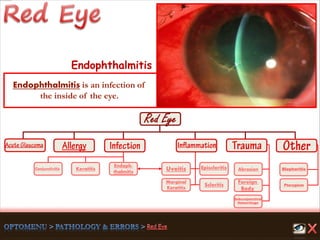 Endoph-
thalmitis
Keratitis
Scleritis
Marginal
Keratitis
Uveitis
Foreign
Body
Abrasion
Pterygium
Conjunctivitis
Subconjunctival
Hemorrhage
Episcleritis Blepharitis
Endophthalmitis
Endophthalmitis is an infection of
the inside of the eye.
 