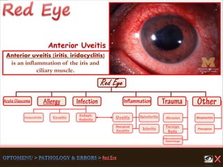 Endoph-
thalmitis
Keratitis
Scleritis
Marginal
Keratitis
Uveitis
Foreign
Body
Abrasion
Pterygium
Conjunctivitis
Subconjunctival
Hemorrhage
Episcleritis Blepharitis
Anterior Uveitis
Anterior uveitis (iritis, iridocyclitis)
is an inflammation of the iris and
ciliary muscle.
 