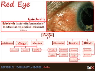 Endoph-
thalmitis
Keratitis
Scleritis
Marginal
Keratitis
Uveitis
Foreign
Body
Abrasion
Pterygium
Conjunctivitis
Subconjunctival
Hemorrhage
Episcleritis Blepharitis
Episcleritis
Episcleritis is a focal inflammation of
the deep subconjunctival (episcleral)
tissue.
 