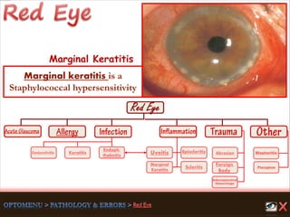 Endoph-
thalmitis
Keratitis
Scleritis
Marginal
Keratitis
Uveitis
Foreign
Body
Abrasion
Pterygium
Conjunctivitis
Subconjunctival
Hemorrhage
Episcleritis Blepharitis
Marginal Keratitis
Marginal keratitis is a
Staphylococcal hypersensitivity
 