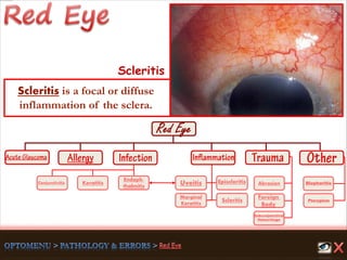 Endoph-
thalmitis
Keratitis
Scleritis
Marginal
Keratitis
Uveitis
Foreign
Body
Abrasion
Pterygium
Conjunctivitis
Subconjunctival
Hemorrhage
Episcleritis Blepharitis
Scleritis
Scleritis is a focal or diffuse
inflammation of the sclera.
 