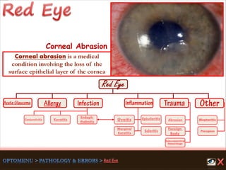 Endoph-
thalmitis
Keratitis
Scleritis
Marginal
Keratitis
Uveitis
Foreign
Body
Abrasion
Pterygium
Conjunctivitis
Subconjunctival
Hemorrhage
Episcleritis Blepharitis
Corneal Abrasion
Corneal abrasion is a medical
condition involving the loss of the
surface epithelial layer of the cornea
 