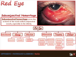 Endoph-
thalmitis
Keratitis
Scleritis
Marginal
Keratitis
Uveitis
Foreign
Body
Abrasion
Pterygium
Conjunctivitis
Subconjunctival
Hemorrhage
Episcleritis Blepharitis
Subconjunctival Hemorrhage
Subconjunctival hemorrhage occur due
to burst of the weak-walled conjunctival
vessels, especially in the elderly.
 